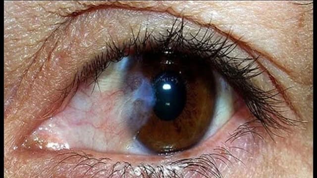 Tìm hiểu thông tin đầy đủ và điều trị mộng thịt ở mắt