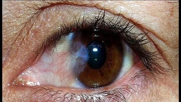 Mộng thịt là một khối mô sợi bất thường phát triển từ kết mạc lan dần vào giác mạc.