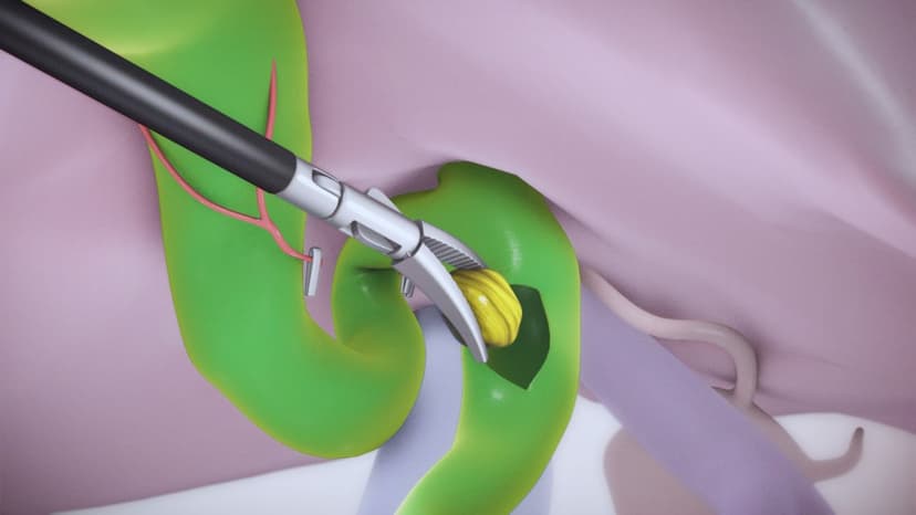 Điều trị sỏi túi mật: Khi nào là thời điểm vàng để can thiệp