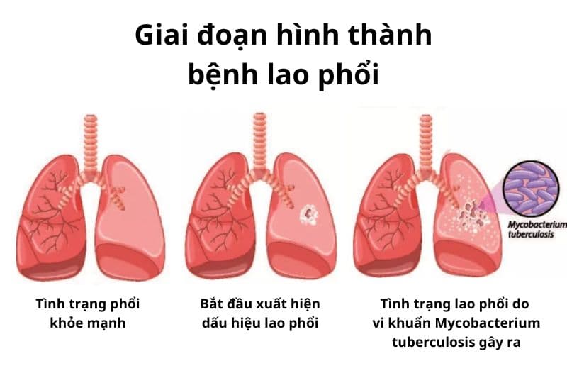 bệnh lao phổi là gì