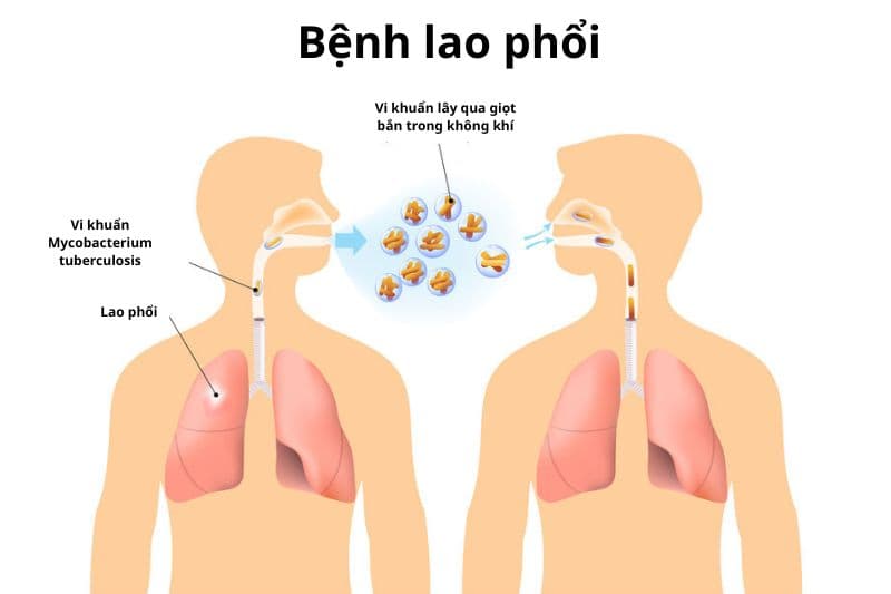 giữ gìn vệ sinh không gian xung quanh khi mắc lao phổi