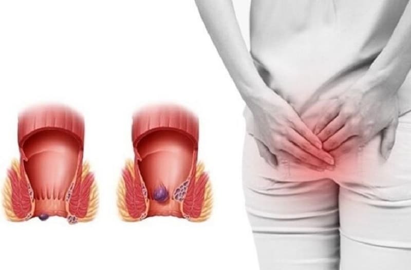 Hiện tượng bị trĩ nội thường đi kèm cảm giác đau rát khi đi vệ sinh, đặc biệt khi búi trĩ đã phát triển
