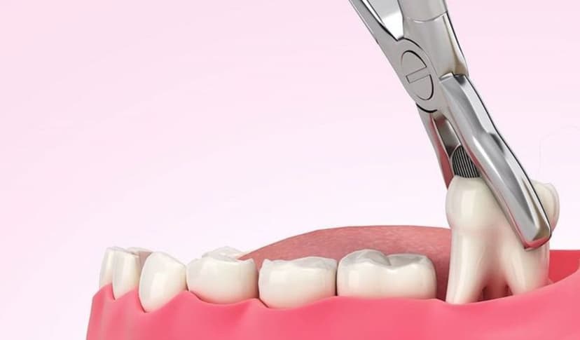 Giải đáp: Khi nào nhổ răng khôn để tránh biến chứng nguy hiểm