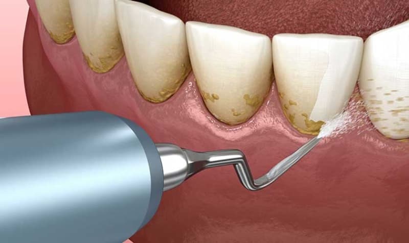 Kỹ thuật lấy cao răng thủ công dựa vào các dụng cụ nha khoa có đầu móc hoặc nhọn để làm sạch mảng bám và vôi răng theo cách trực tiếp