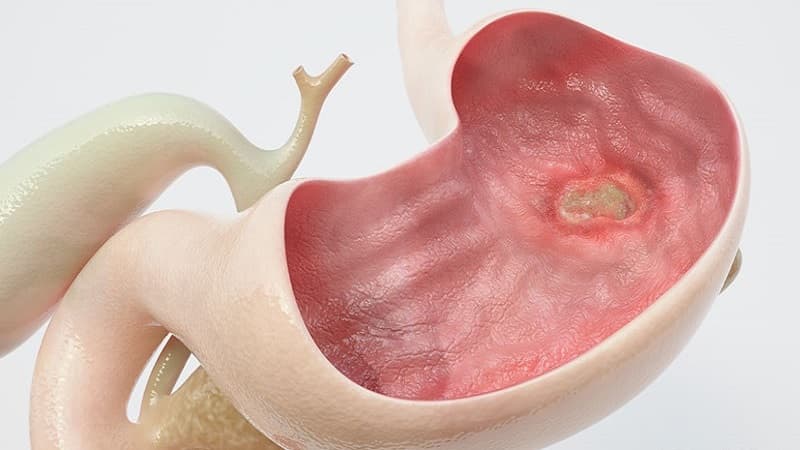 lưu ý loét dạ dày