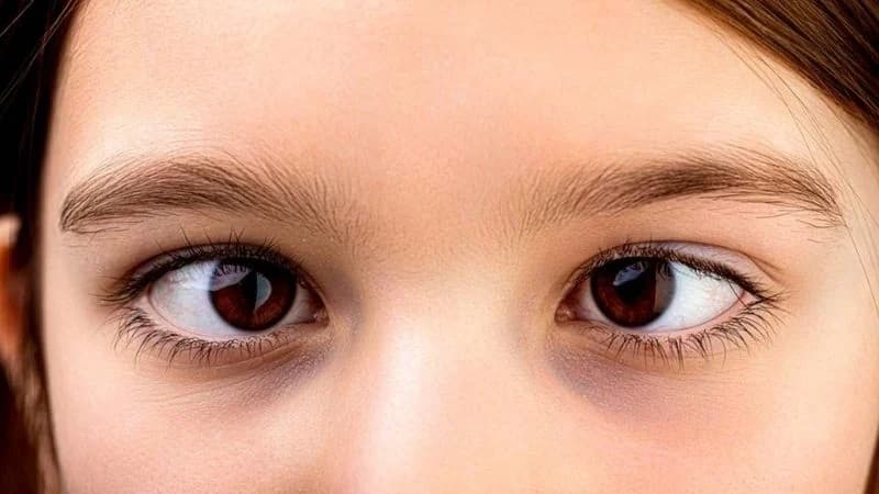 Mắt lác nhẹ là một dạng rối loạn thị giác trong đó hai mắt không đồng nhất trong chuyển động hoặc hướng nhìn.