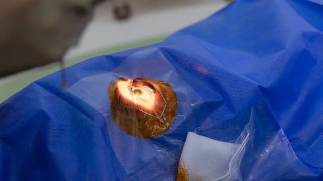 Mổ Phaco chữa cận thị: Giải pháp hiện đại cho đôi mắt sáng rõ