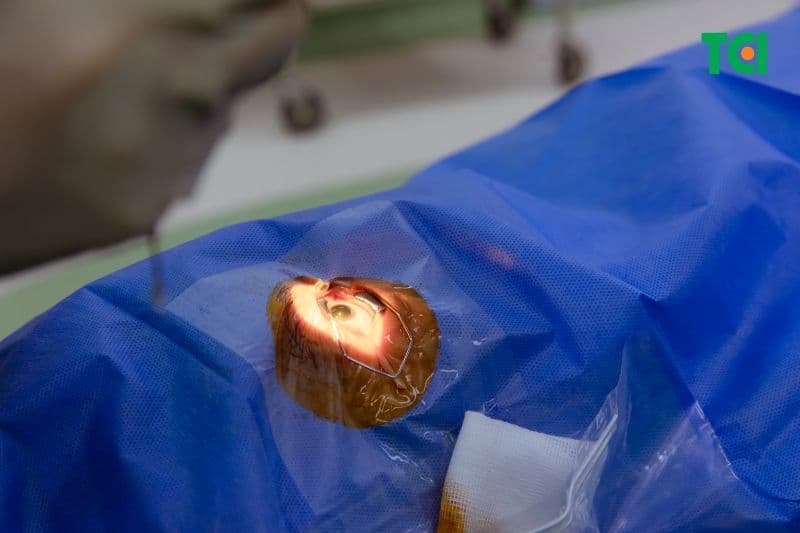 mổ phaco chữa cận thị