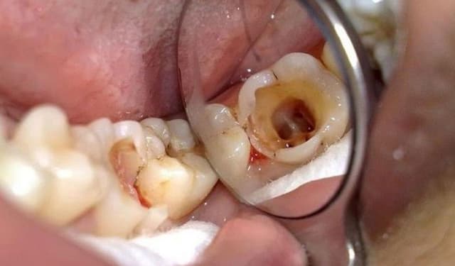 Hậu quả tiềm ẩn khi người bị sâu răng chậm trễ điều trị