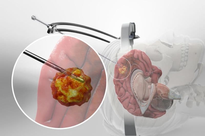 điều cần biết về sinh thiết não