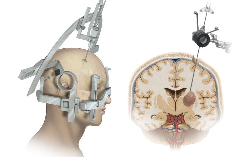 sinh thiết kim ưu tiên khi tổn thương nằm sâu trong não