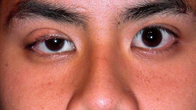 Nhược cơ nâng mi – Nguyên nhân và giải pháp điều trị hiệu quả