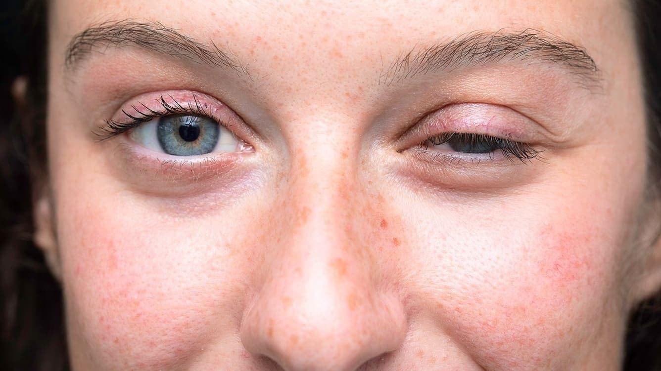 Nhược cơ nâng mi là một tình trạng bệnh lý ảnh hưởng đến cơ nâng mi mắt.