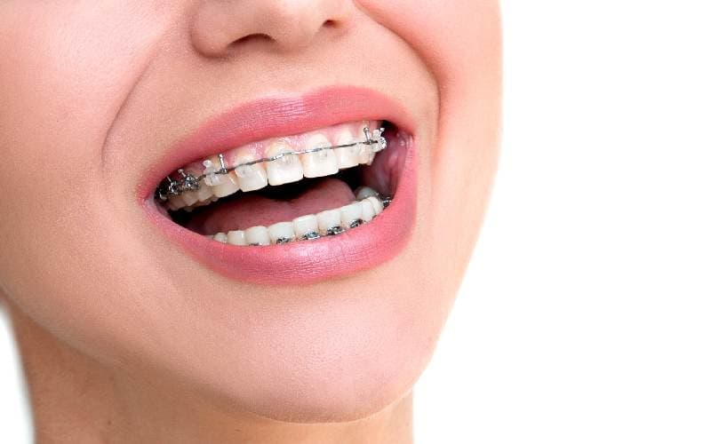 Niềng răng đau không nhỉ