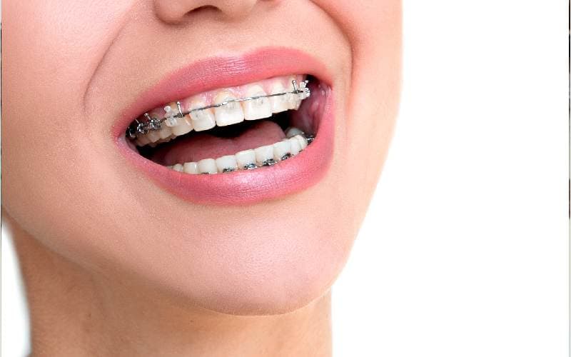 Niềng răng thẩm mỹ bao lâu