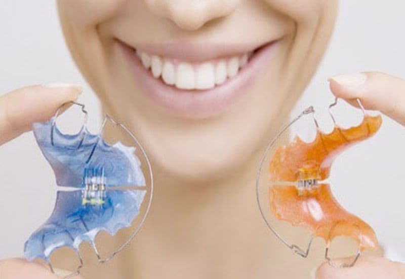 Niềng răng tháo lắp phù hợp với người ưu tiên thẩm mỹ.