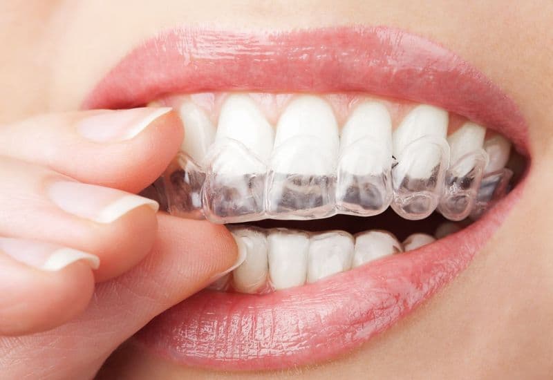 Niềng răng tháo lắp trong suốt như Invisalign được đánh giá cao về tính tiện lợi và thẩm mỹ.