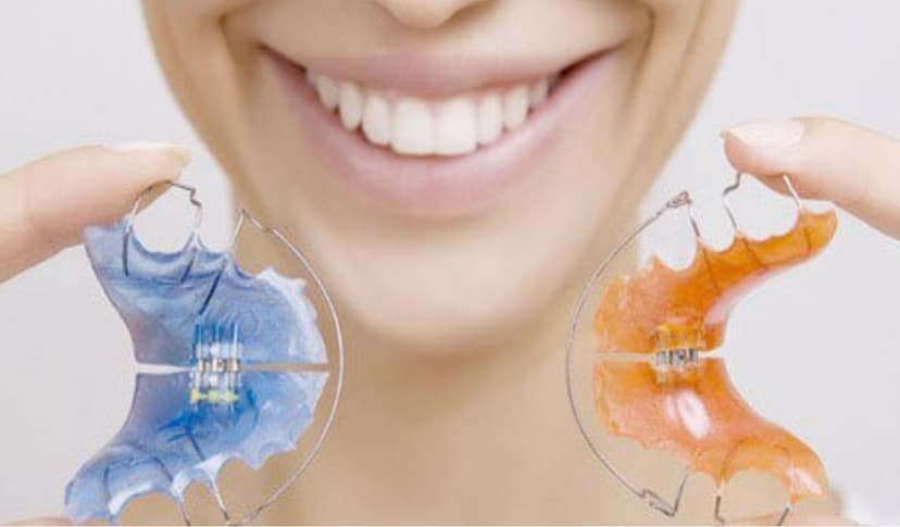 Niềng răng tháo lắp và những ưu nhược điểm bạn cần biết