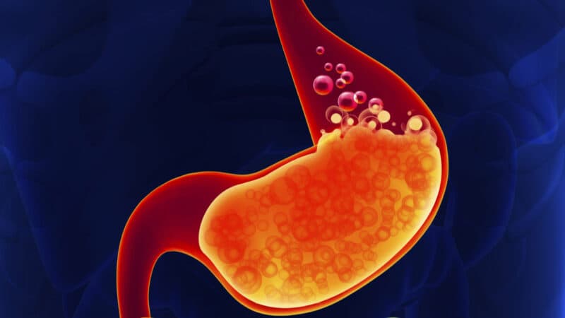 Trào ngược dạ dày dễ gây ợ chua va buồn nôn