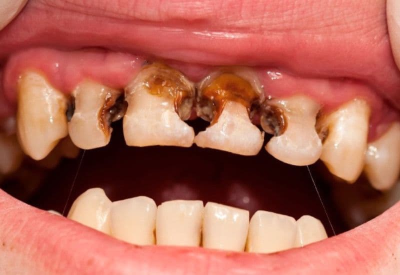 Răng sâu bị đau kéo dài khiến sinh hoạt hàng ngày bị xáo trộn và kém thoải mái.