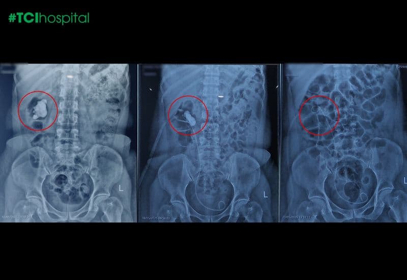 Tán sạch sỏi lâu năm bám chặt như các mảng “rỉ sét” trong bể thận