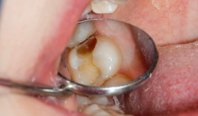 Sâu răng đến tủy: Dấu hiệu nhận biết và cách điều trị hiệu quả