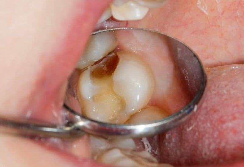 Sâu răng đến tủy là hậu quả nguy hiểm khi không điều trị sâu răng đúng lúc.