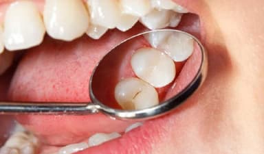 Sâu răng hàm nhẹ: Dấu hiệu ban đầu và cách xử lý đúng cách