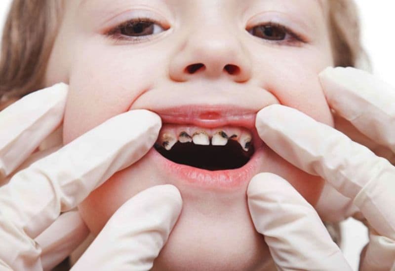 Tình trạng sâu răng ở trẻ ngày càng trở nên phổ biến, ảnh hưởng không nhỏ đến sức khỏe răng miệng của các em.