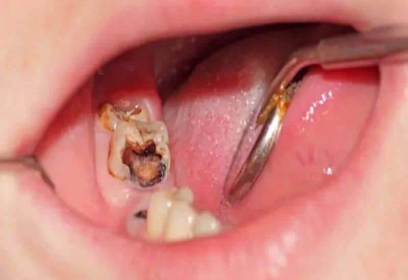 Sâu tủy răng ảnh hưởng không nhỏ đến sinh hoạt và chất lượng cuộc sống của nhiều người.