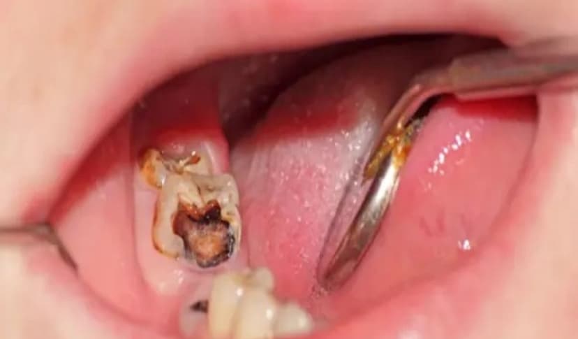 Sâu tủy răng: Những dấu hiệu điển hình và cách điều trị hiệu quả