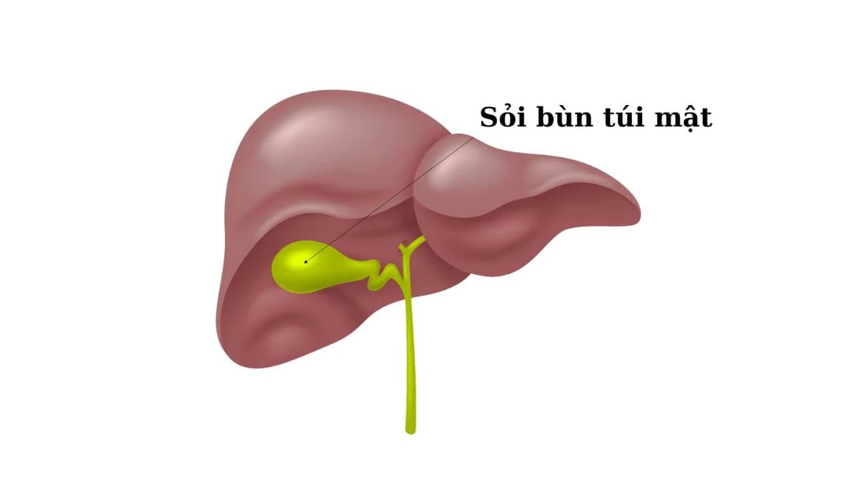 Sỏi bùn túi mật là gì? Dấu hiệu nhận biết, cách điều trị, phòng ngừa