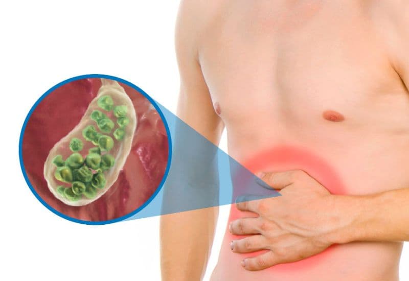 Sỏi đường mật trong gan là gì?