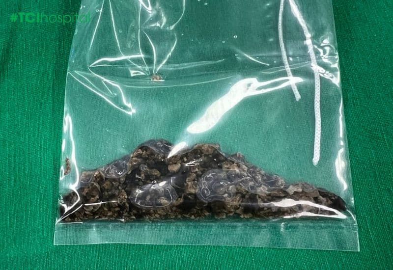 Lấy sạch vụn sỏi như các mảng rỉ sét kết chặt trong bể thận