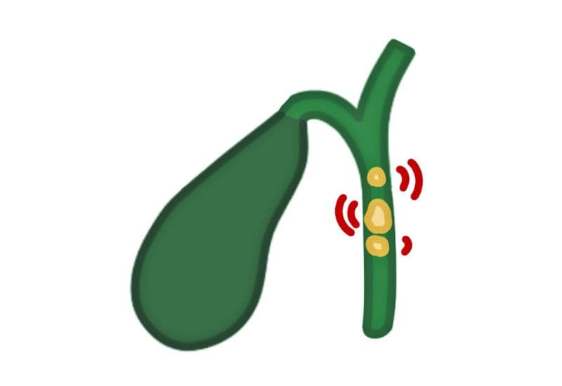 Sỏi mật có tan được không? Câu trả lời từ chuyên gia