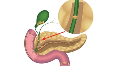 Sỏi mật có tan được không? Chuyên gia lý giải chi tiết