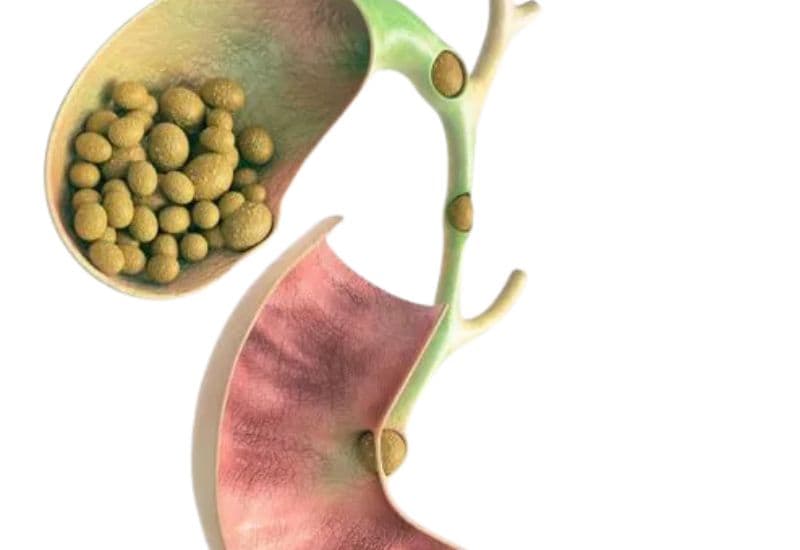 Khi nào sỏi túi mật trở nên nguy hiểm?