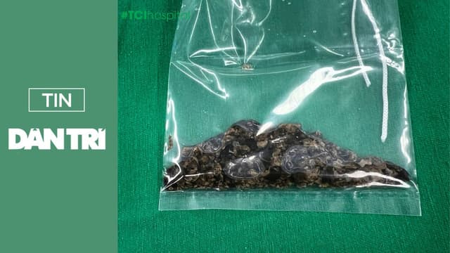 Tán sạch sỏi lâu năm bám chặt như các mảng “rỉ sét” trong bể thận