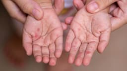 Thời gian ủ bệnh tay chân miệng ở trẻ