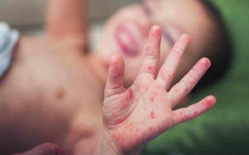 Thời gian ủ bệnh tay chân miệng nguy hiểm không