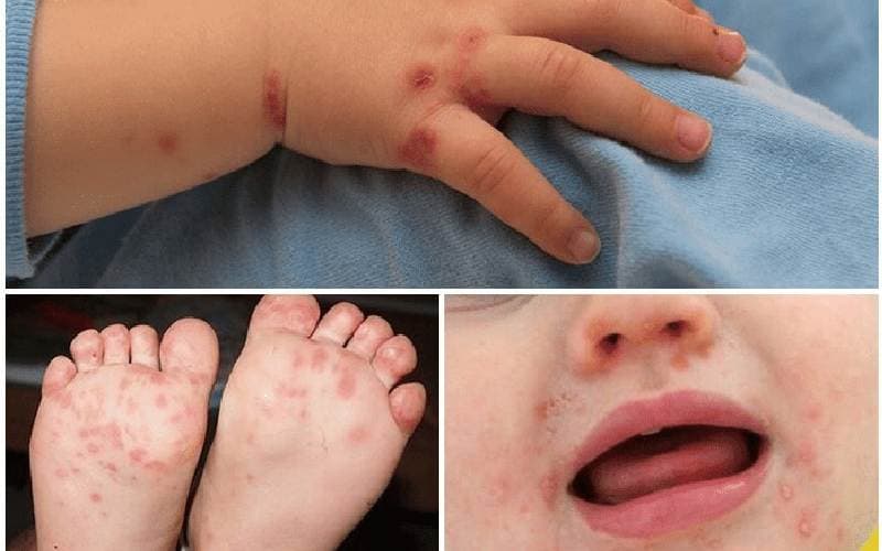 Dấu hiệu Thời gian ủ bệnh tay chân miệng