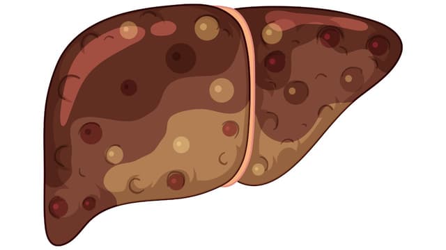 Gan nhiễm mỡ là gì, cách chẩn đoán, điều trị