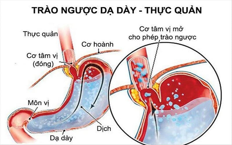 Cần thăm khám với bác sĩ Tiêu hóa để có chỉ định dùng thuốc phù hợp.