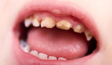 Trẻ em sâu răng: Nguyên nhân, dấu hiệu và cách phòng ngừa
