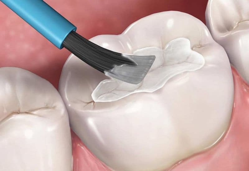 Trị sâu răng nhẹ hiệu quả không thể bỏ qua phương pháp trám răng phòng ngừa.