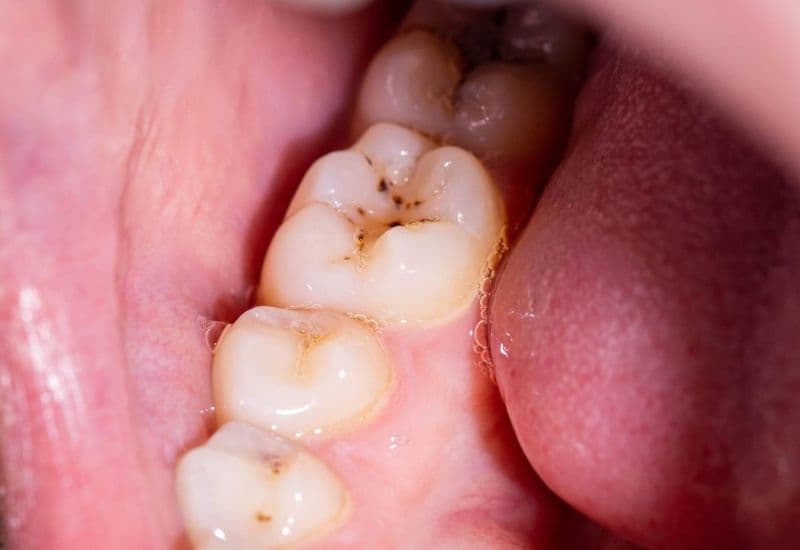 Sâu răng nhẹ là bước đầu tiên của quá trình bệnh lý, thường khởi phát khi men răng bị ảnh hưởng.