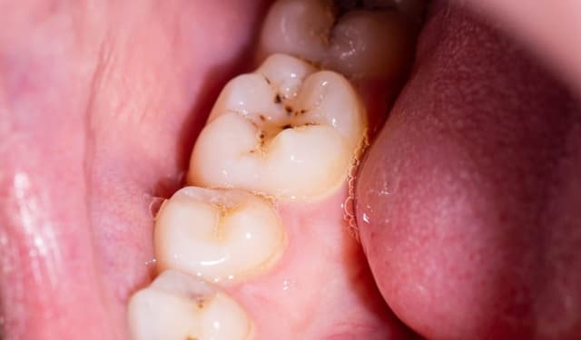 5 sai lầm thường gặp khi chủ quan không trị răng sâu nhẹ