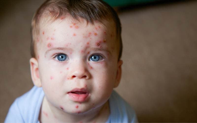 Triệu chứng của bệnh thủy đậu ở trẻ em