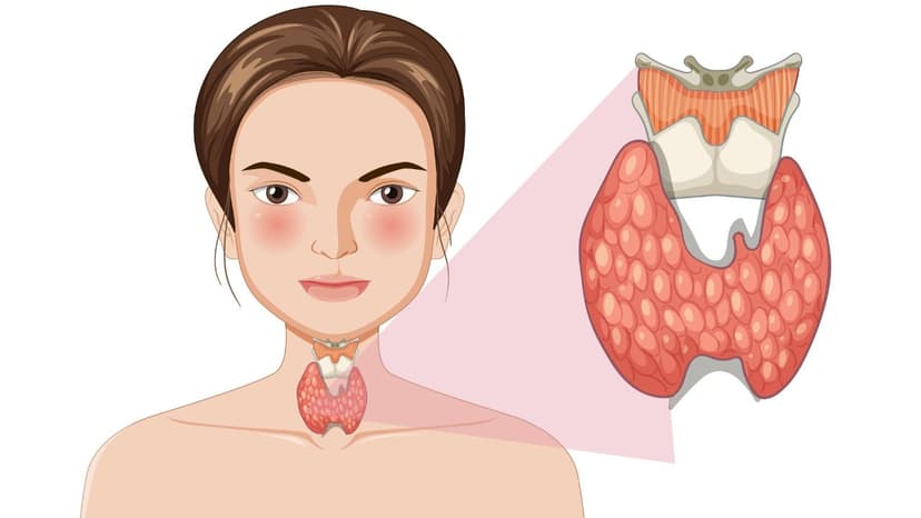 Triệu chứng cường giáp trên lâm sàng và chẩn đoán y khoa