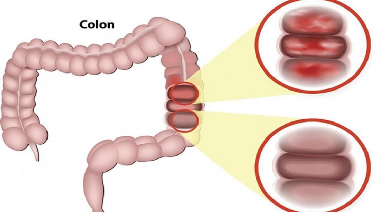 Viêm loét đại tràng chảy máu: Hiểu rõ để điều trị đúng cách